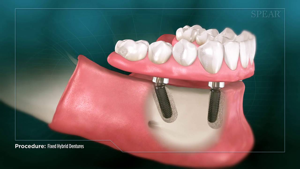 Illustration of all-on-4 Dental Implants