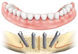 Illustration of all on 4 dental implants